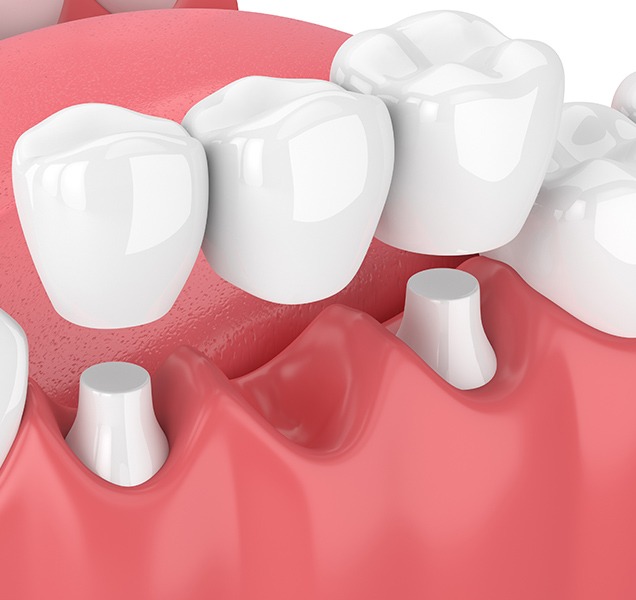Dental Bridges | Harmony Family Dental Care | Springbank General and Family Dentist