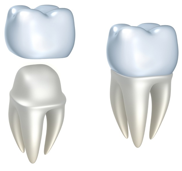 Dental Crowns | Harmony Family Dental Care | Springbank General and Family Dentist
