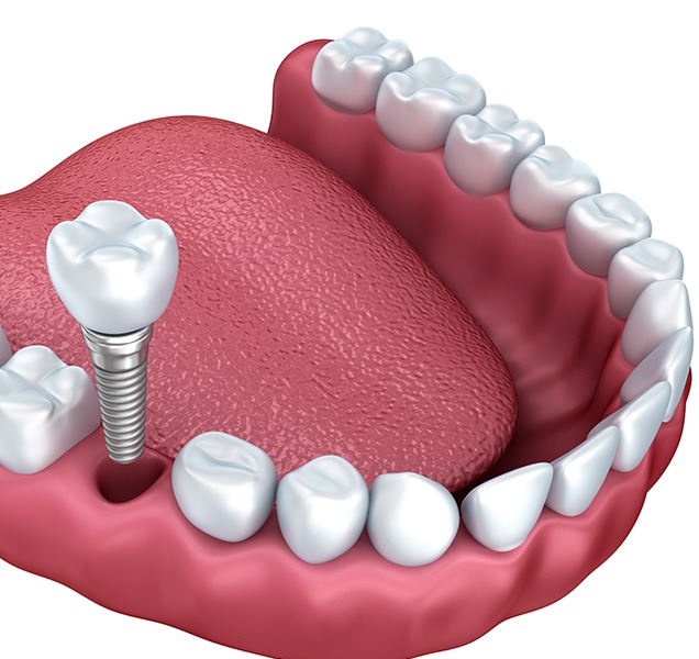 Dental Implant Crowns | Harmony Family Dental Care | Springbank General and Family Dentist