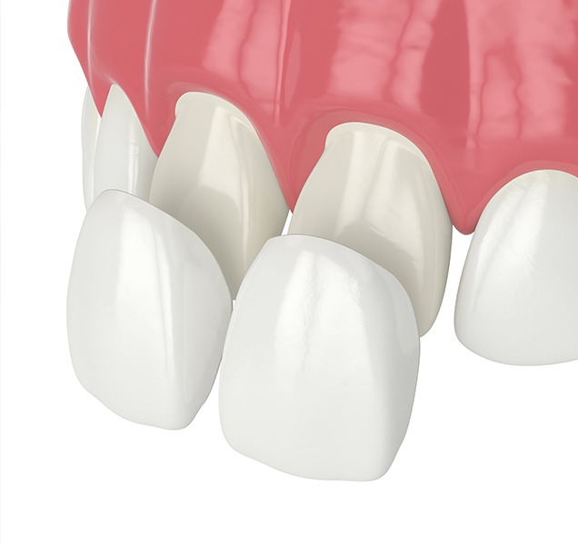 What are porcelain veneers | Harmony Family Dental Care | Springbank General and Family Dentist