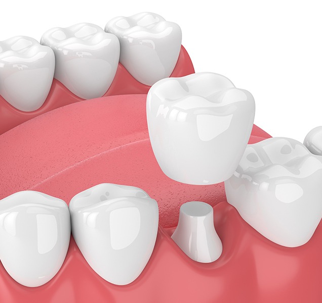 What is a dental crowns | Harmony Family Dental Care | Springbank General and Family Dentist