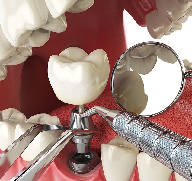 What is a Dental Implant Crowns | Harmony Family Dental Care | Springbank General and Family Dentist