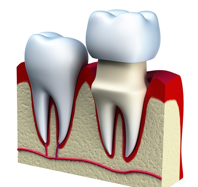 What is restorative dentistry | Harmony Family Dental Care | Springbank General and Family Dentist