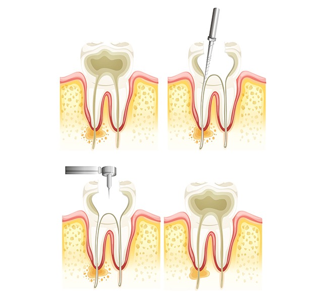 What is Root Canal Therapy | Harmony Family Dental Care | Springbank General and Family Dentist