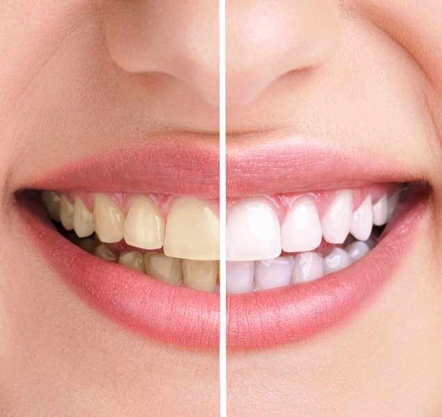What is Teeth Whitening | Harmony Family Dental Care | Springbank General and Family Dentist