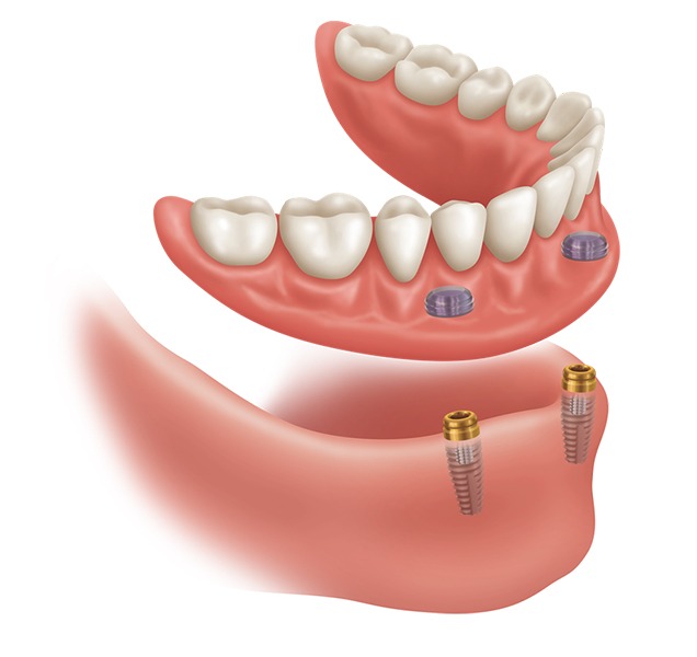 Implant Supported Dentures | Harmony Family Dental Care | Springbank General and Family Dentist